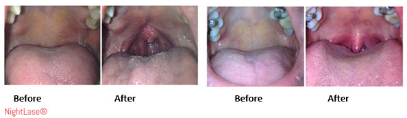 NON-Surgical Laser Snoring Treatment 